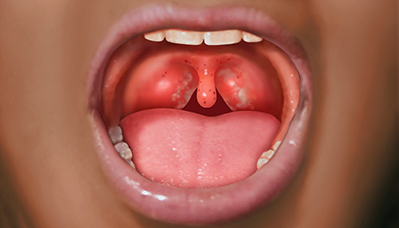 streptococcal pharyngitis spread