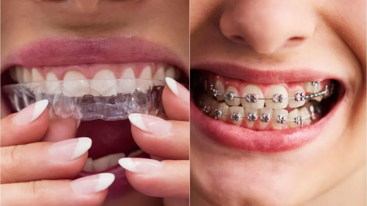 Comparing Invisalign and Traditional Braces: A Guide for Patients in the UK