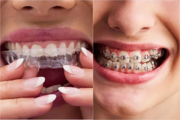 comparing invisalign and traditional braces